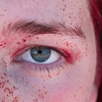 Диагностическая дилемма: яд черной вдовы отравил женщину через глазное яблоко