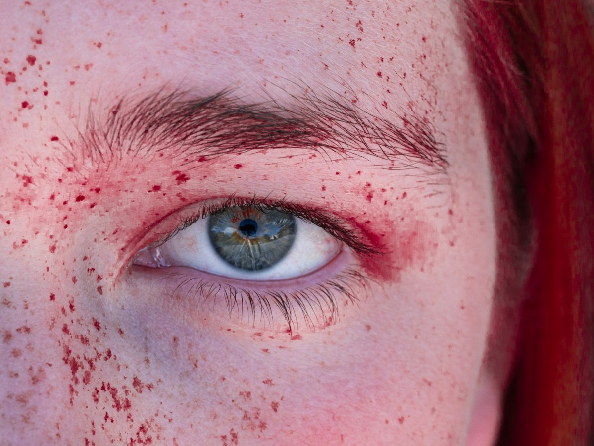 Диагностическая дилемма: яд черной вдовы отравил женщину через глазное яблоко